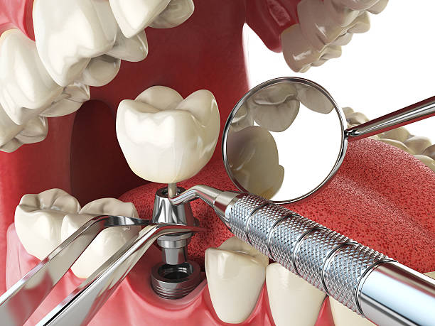 Best Emergency Cosmetic Dentistry (e.g., broken veneers) in East Sonora, CA